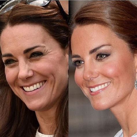 kate middleton before and after surgery